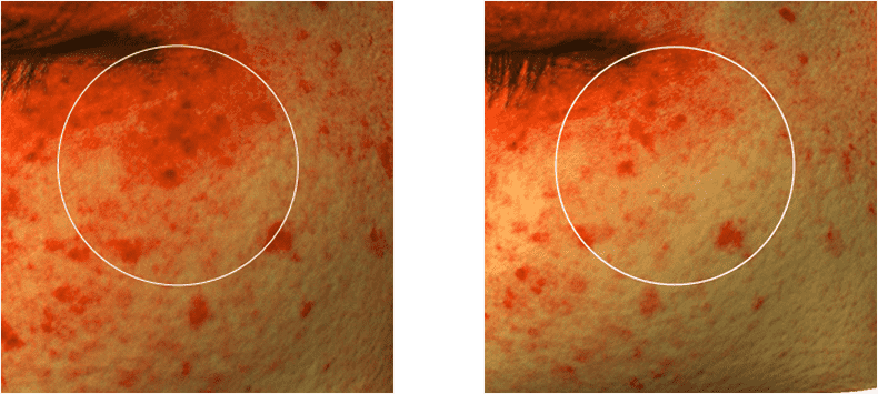 설화수 자정앰플세럼 피험자 색소침착 잡티 개선 이미지